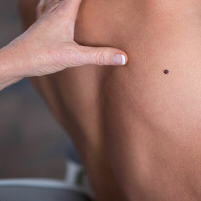 Effective Ways to Lower the Risk of Melanoma