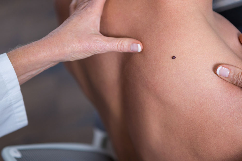 Effective Ways to Lower the Risk of Melanoma