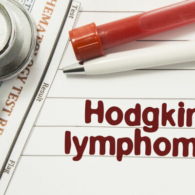 7 Risk Factors for Hodgkin&#8217;s Lymphoma