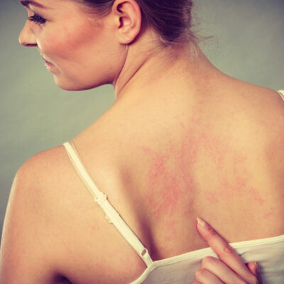 6 Health Conditions Linked to Psoriasis and Treatment Options